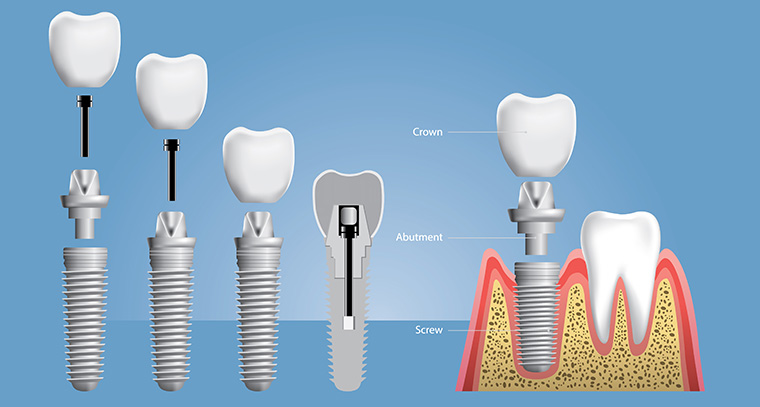 Dental Implant | Dentist in San Jose, CA | Dr. Pauline Lu, DDS